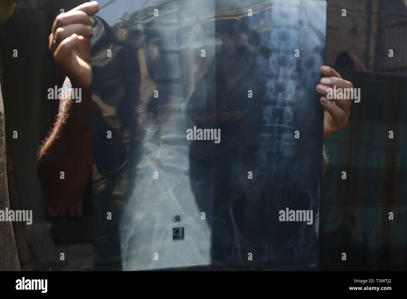 Joyputhat, au Bangladesh. 12 avr, 2019. Victime d'un organe illégal le commerce, montre son x ray rapport dans un village voisin de la partie nord du district de Joypurhat dans du pays. Dans quelques années, des centaines de personnes rurales tombent dans la tentation par trafiquant à vendre leurs organes pour obtenir des avantages financiers près de Entourage Village Quartier de Joypurhat partie nord du pays. Credit : MD Mehedi Hasan/ZUMA/Alamy Fil Live News Banque D'Images Joyputhat, au Bangladesh. 12 avr, 2019. Victime d'un organe illégal le commerce, montre son x ray rapport dans un village voisin de la partie nord du district de Joypurhat dans du pays. Dans quelques années, des centaines de personnes rurales tombent dans la tentation par trafiquant à vendre leurs organes pour obtenir des avantages financiers près de Entourage Village Quartier de Joypurhat partie nord du pays. Credit : MD Mehedi Hasan/ZUMA/Alamy Fil Live News Banque D'Images