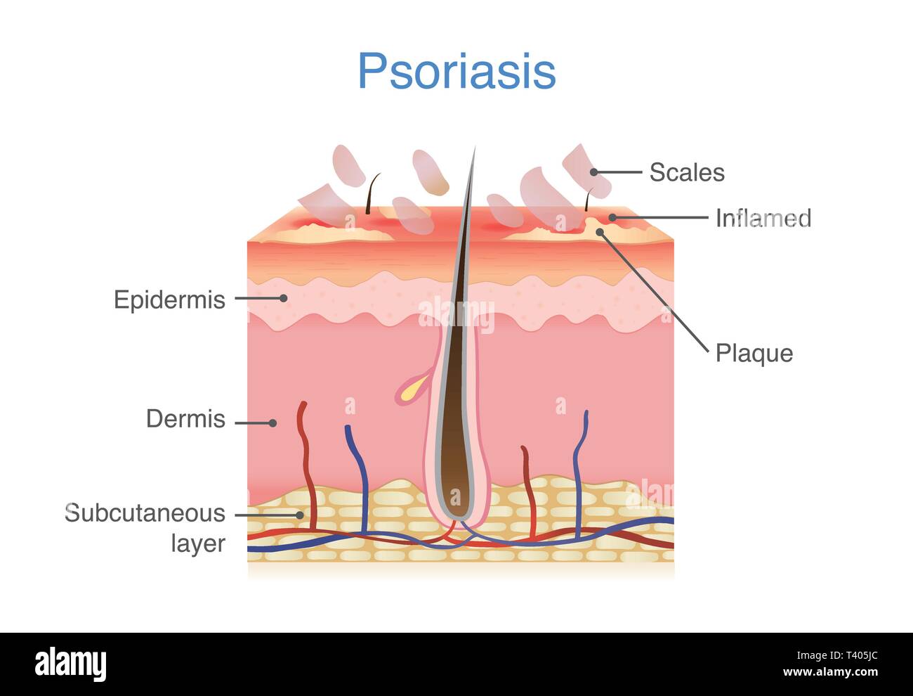 La couche de peau humaine lorsque le psoriasis en plaques signes et symptômes apparaissent. Illustration de Vecteur