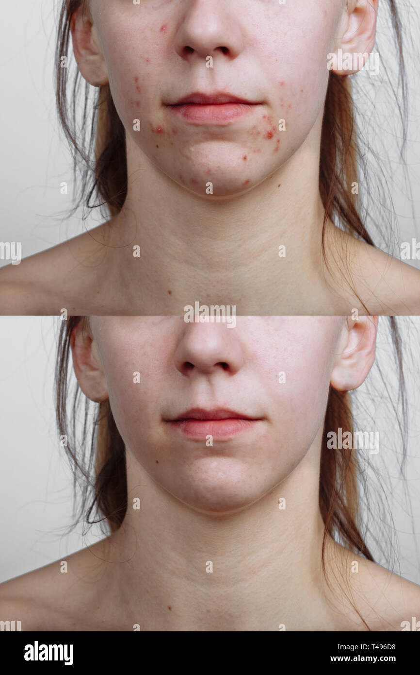 Jeune femme avant et après traitement de l'acné, libre. Concept de soins de la peau Banque D'Images