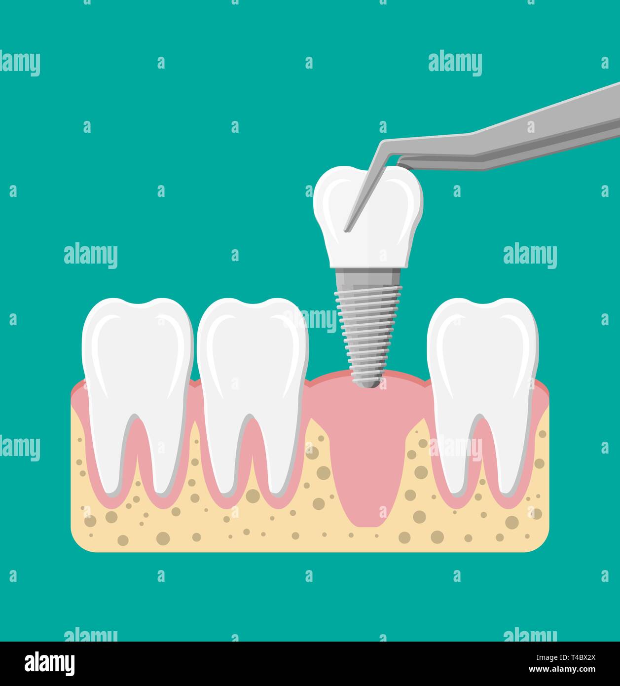 La restauration de la dent. L'installation de l'implant dentaire. Prothèses  dentaires. Les dents artificielles avec la broche en acier. Oral care,  stomatologie et médecine dentaire. Vecto Image Vectorielle Stock - Alamy