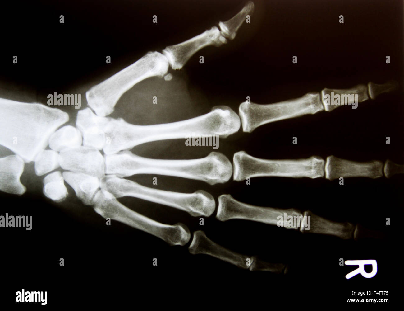 X-ray image de main humaine normale en bonne santé Banque D'Images