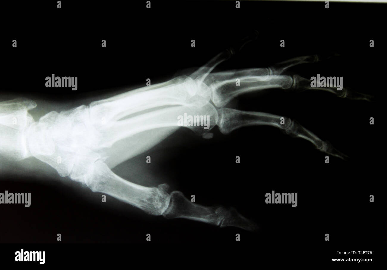 X-ray image de main humaine normale en bonne santé Banque D'Images