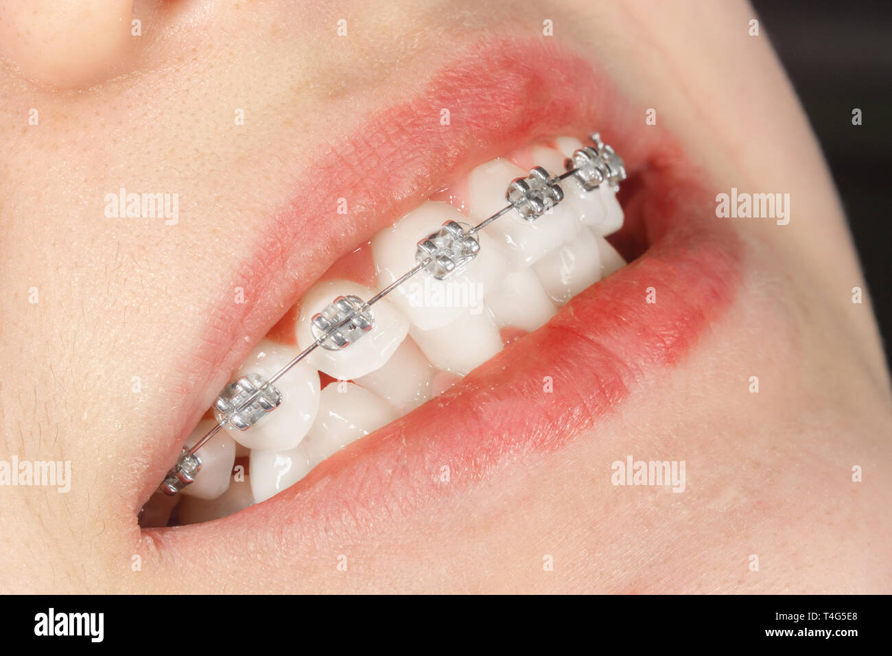 Traitement dentaire par un orthodontiste avec appareil dentaire. Un sourire  et des dents blanches close up Photo Stock - Alamy