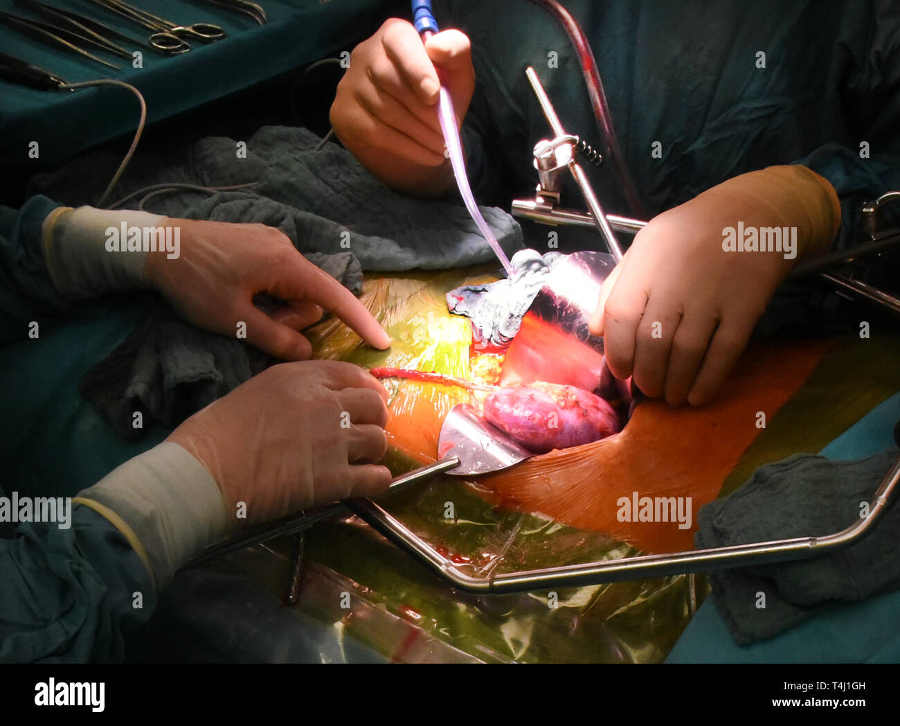 20.03.2019, Saxe, Leipzig : Dans le centre de transplantation à l'hôpital universitaire, un rein pris il y a quelques jours par un donneur sain par le Professeur Dr. med. Daniel Seehofer et médecin principal Sebastian Rademacher transplantés au niveau du récepteur. Dans la Transpantation Centre, qui a été fondée en 1993, plus de 1040 sur le foie et reins 1000 pourraient être transplantés au cours des 25 dernières années. Photo : Waltraud Grubitzsch / dpa-Zentralbild / ZB | conditions dans le monde entier Banque D'Images