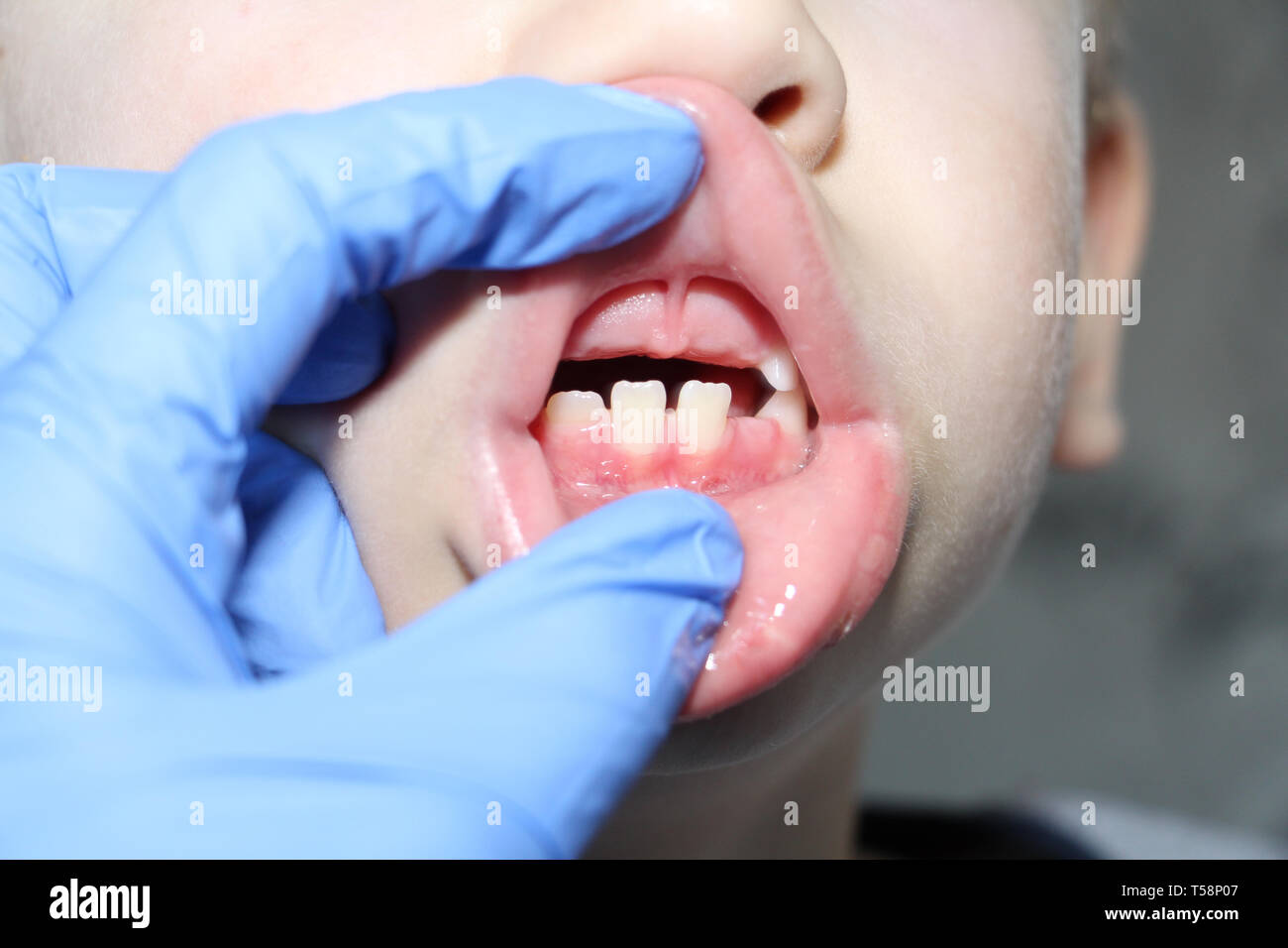 Un dentiste examine les dents de bébé dans le garçon. La perte de dents de lait. Le garçon n'a pas de dents centrale supérieure. La perte de dents de lait chez les enfants. Banque D'Images