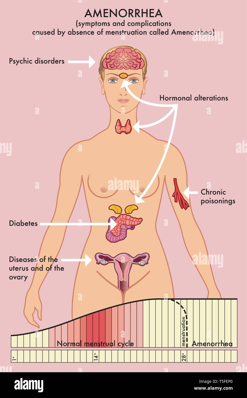 Schéma médical des symptômes et complications causées par l'absence de menstruation appelée aménorrhée. Illustration de Vecteur