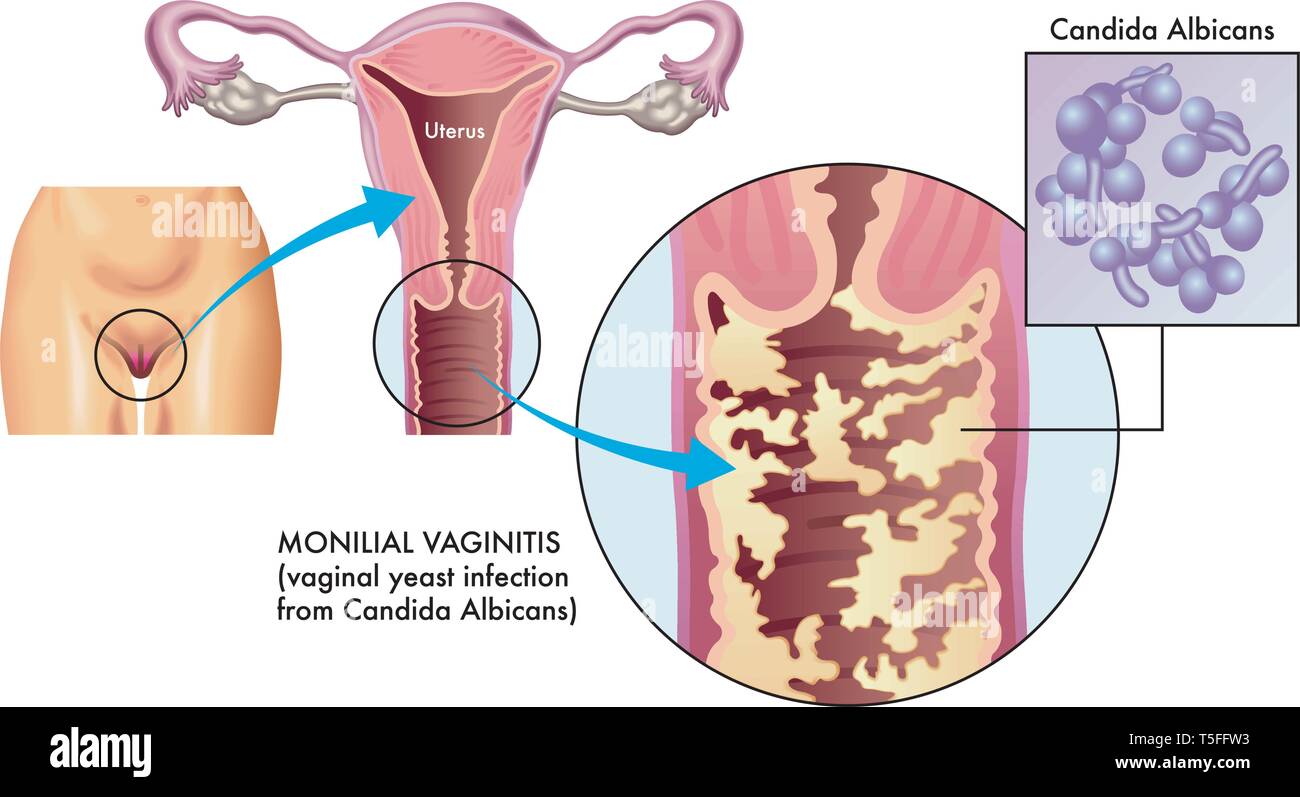 Une illustration médicale de vaginite monilial sur un fond blanc. Illustration de Vecteur