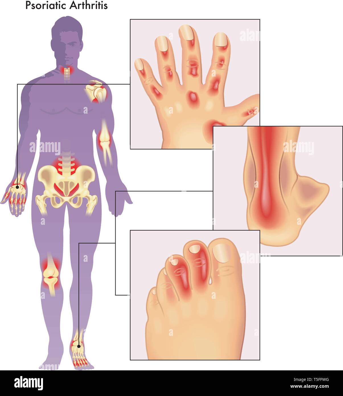 Illustration du corps humain montrant close up d'anatomie effectuée par l'arthrite psoriasique. Illustration de Vecteur