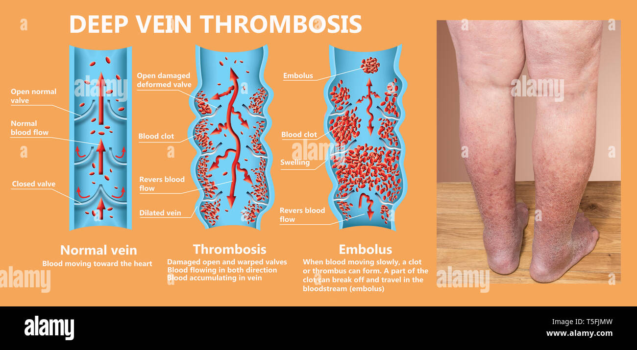 La thrombose. De la normale de la circulation du sang dans la formation de caillot de sang Banque D'Images