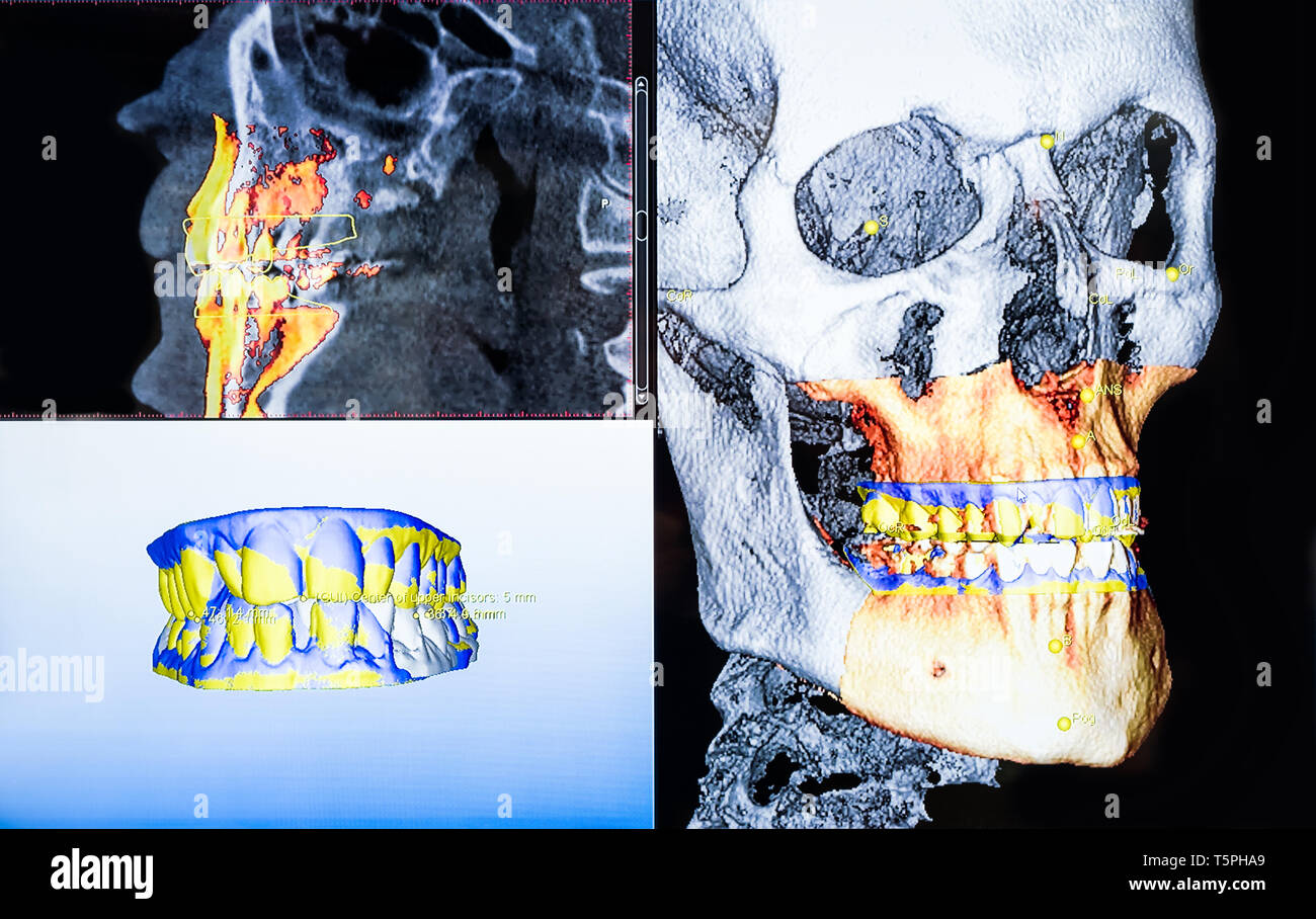 Et panoramique dentaire 3D x-ray de coups Banque D'Images