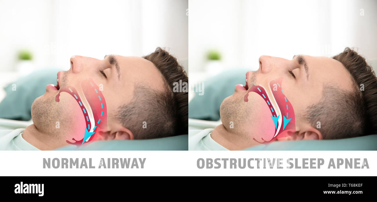 Illustrations montrant différence entre la respiration normale et l'apnée obstructive du sommeil Banque D'Images