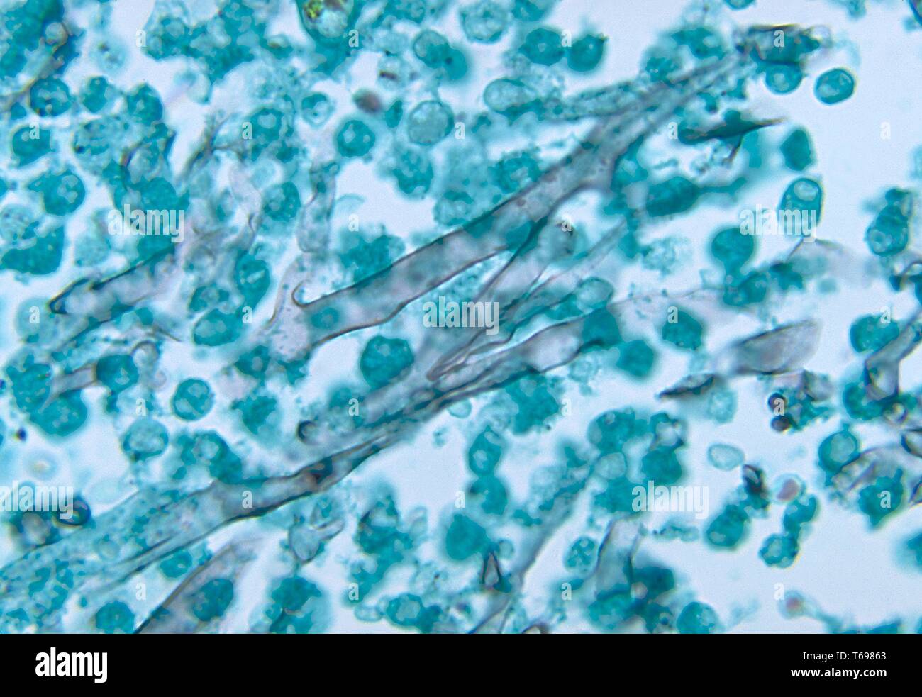 La photomicrographie de changements histopathologiques dans une valve cardiaque due à zygomycosis causé par Mucor pusillus, 1972. Image courtoisie Centres for Disease Control and Prevention (CDC) / Dr. Libero Ajello. () Banque D'Images