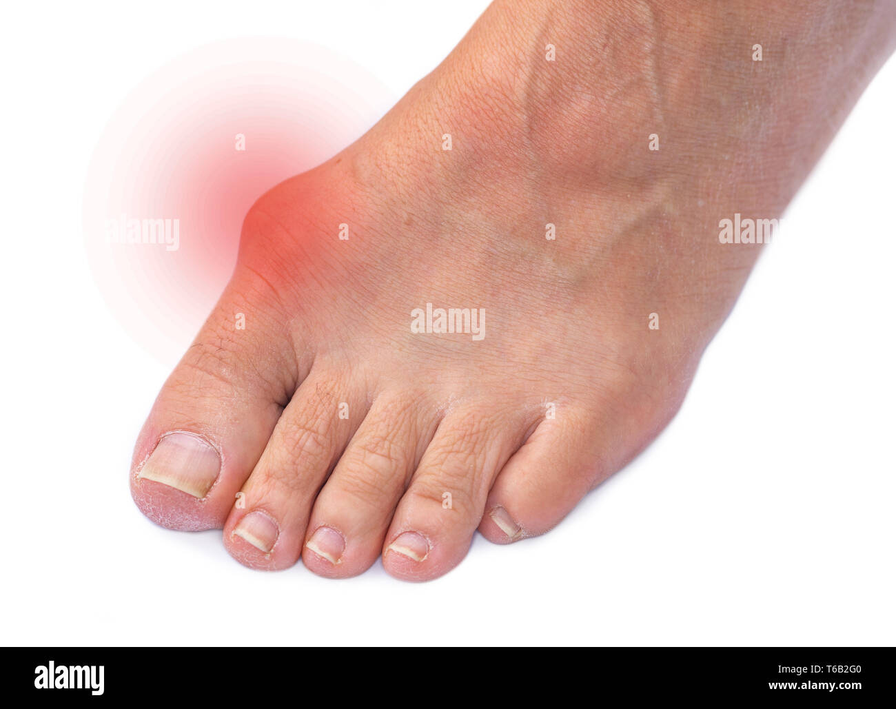 Anatomie pied valgus Banque de photographies et d’images à haute résolution Alamy