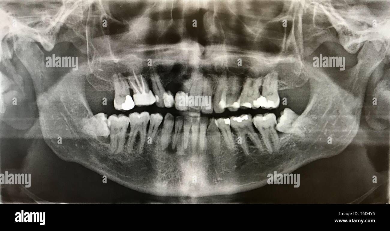 X-ray photo de dents humaines Banque D'Images