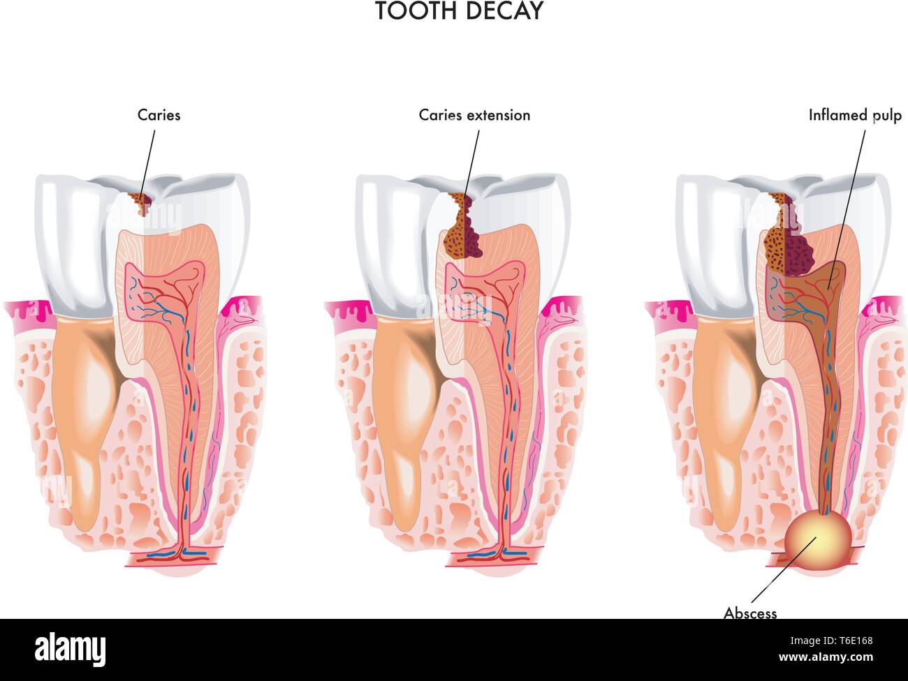 Illustration médicale du processus de la carie dentaire Illustration de Vecteur