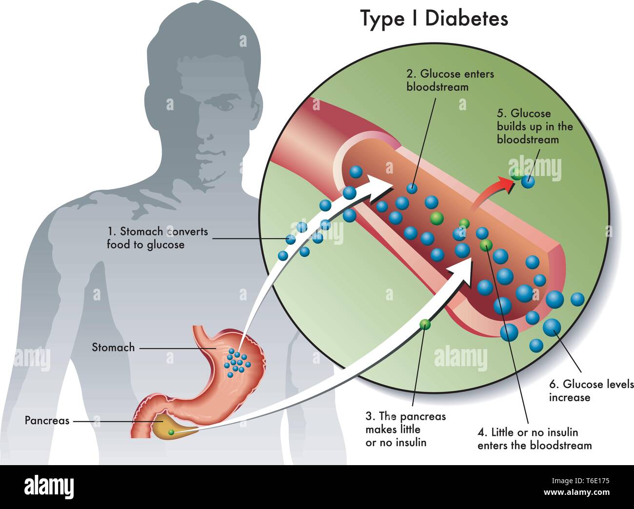 Illustration médicale des symptômes du diabète de type 1 Illustration de Vecteur