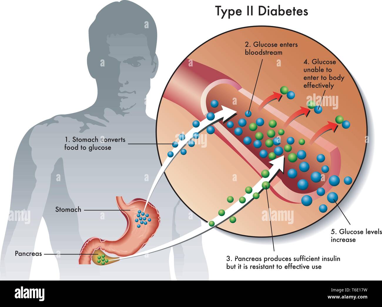 Illustration médicale des symptômes du diabète de type 2 Illustration de Vecteur