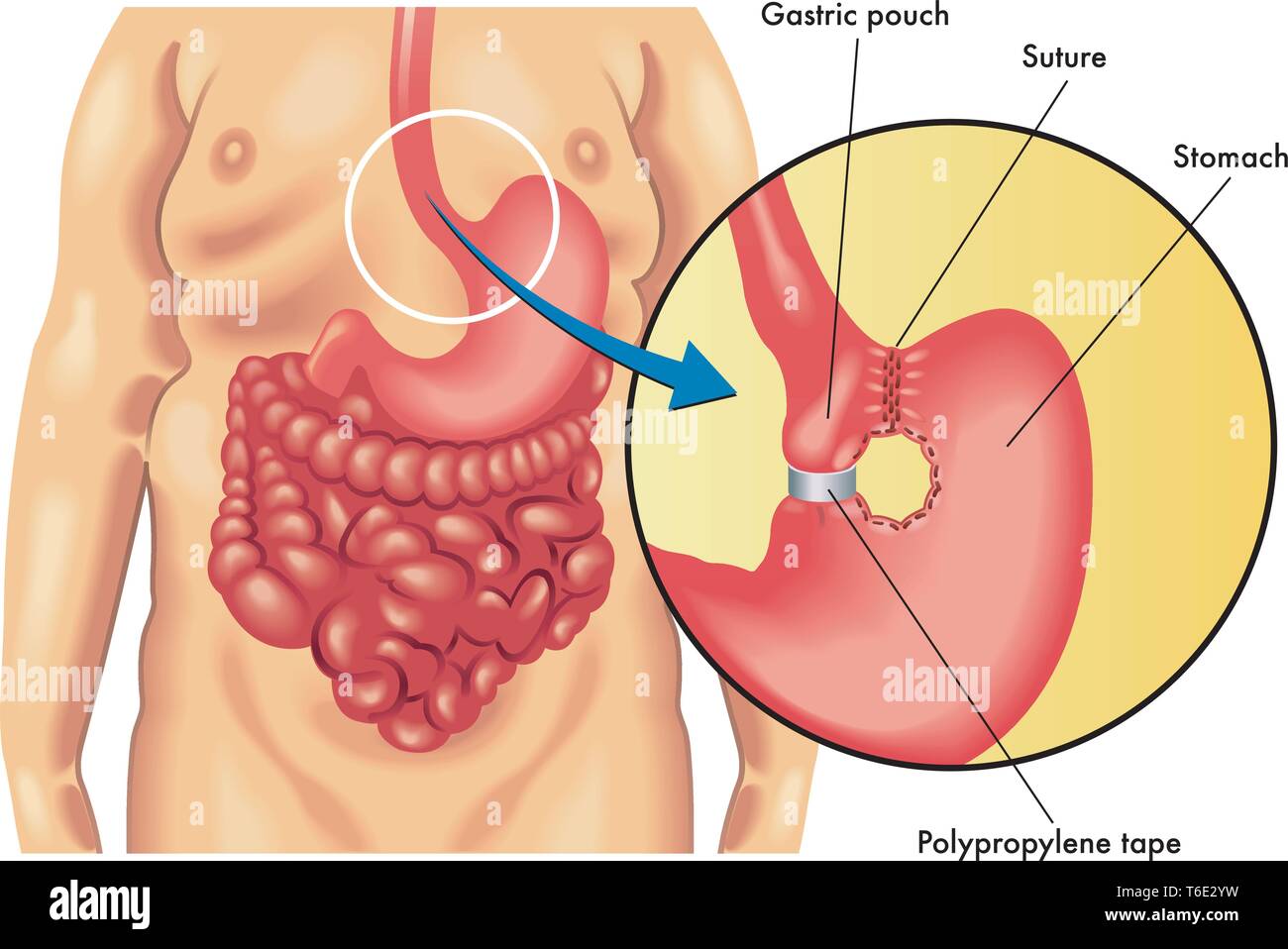 Illustration médicale d'une chirurgie gastroplastie verticale bagués Illustration de Vecteur
