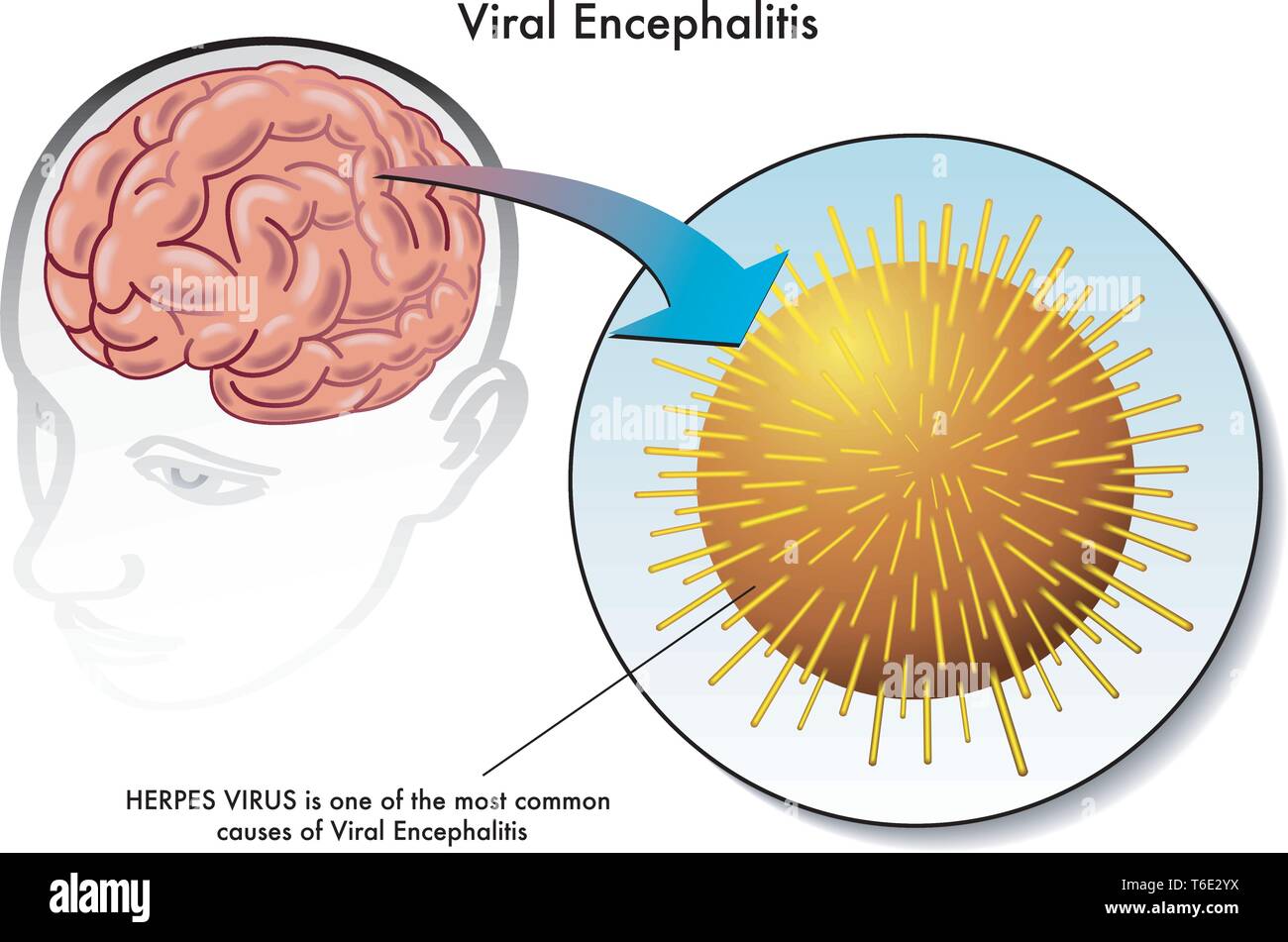 Illustration médicale du virus de l'encéphalite virale Illustration de Vecteur