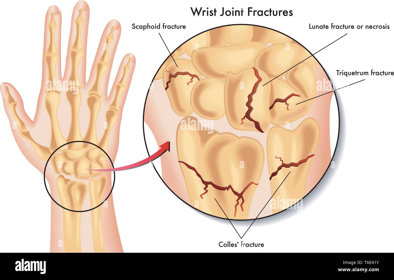 Illustration médicale des différents types de fracture du poignet Illustration de Vecteur