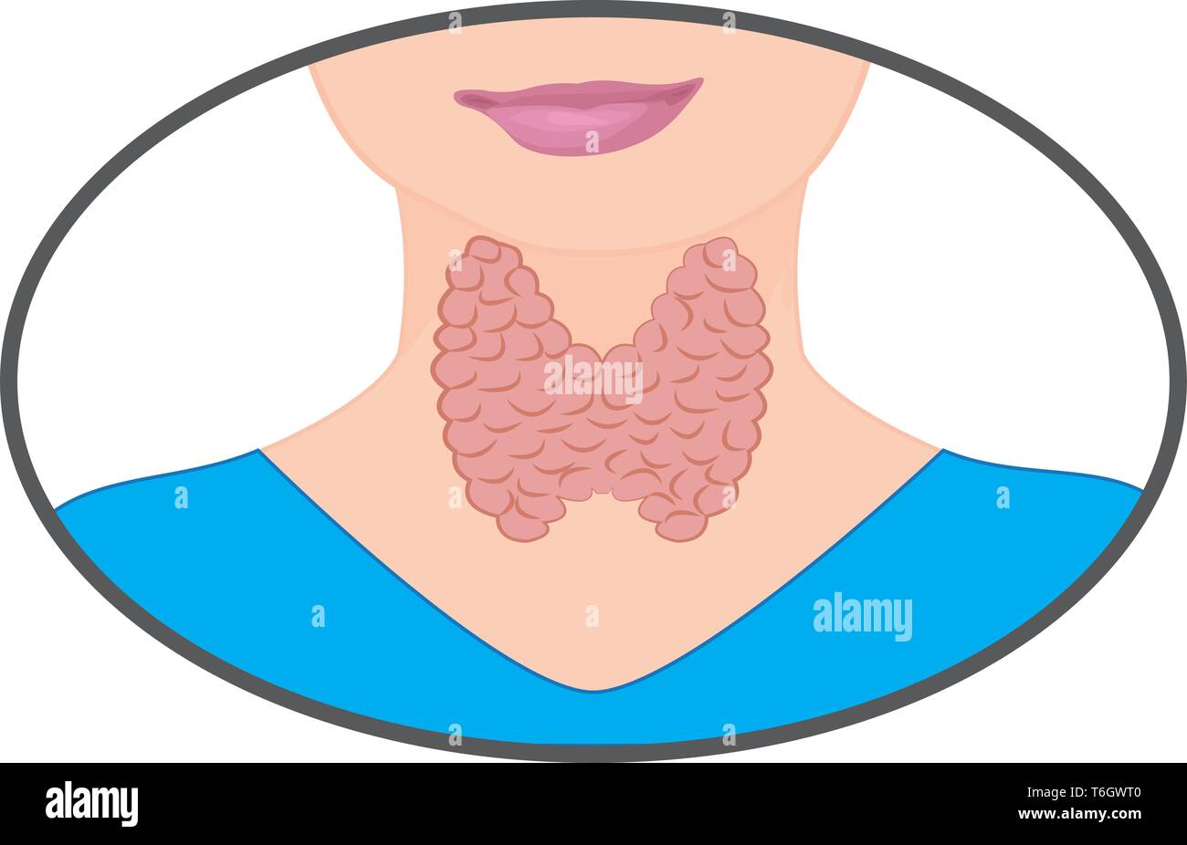 Le goitre. La thyroïde élargie. Dysfonctionnement endocrinien vector illustration sur un fond blanc. L'hyperthyroïdisme Illustration de Vecteur