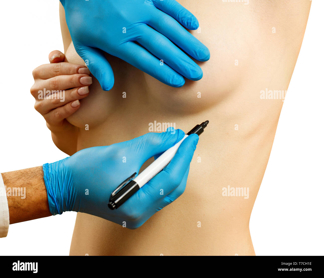 La chirurgie plastique du sein chez la femme avant la correction. Banque D'Images