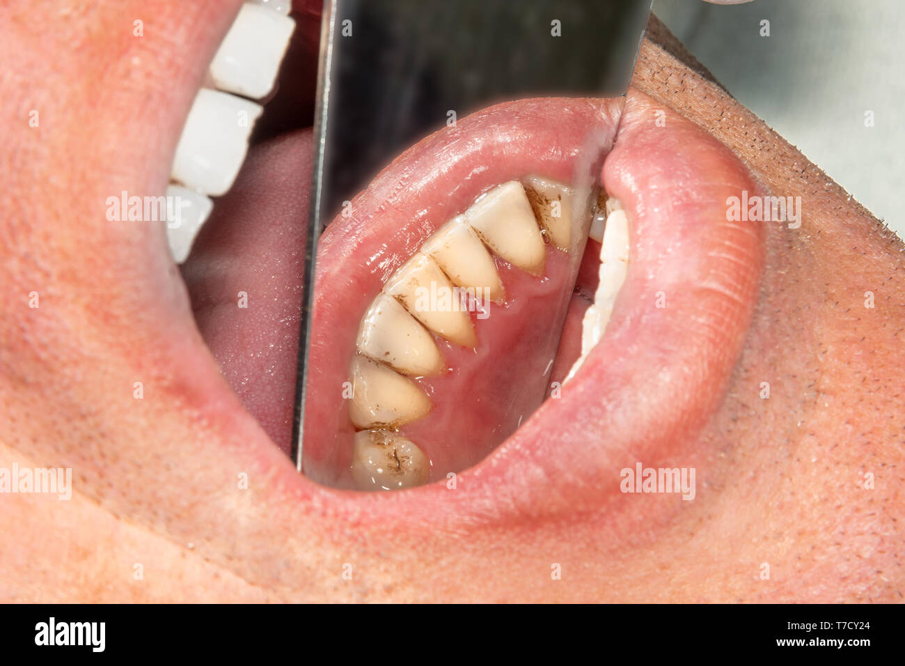 Avec des dents humaines fumeurs la plaque et le tartre. Macro Close-up clinique dentaire. Concept d'hygiène Banque D'Images