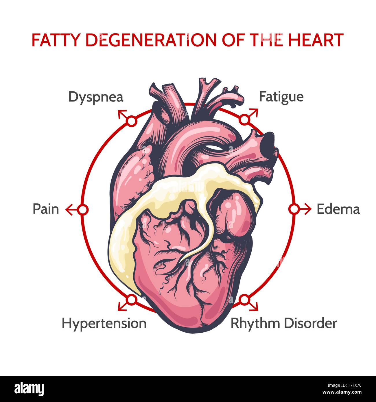 La dégénérescence graisseuse du Cœur. Principaux symptômes de la maladie. Cardiologie médicale illustration vectorielle. Illustration de Vecteur