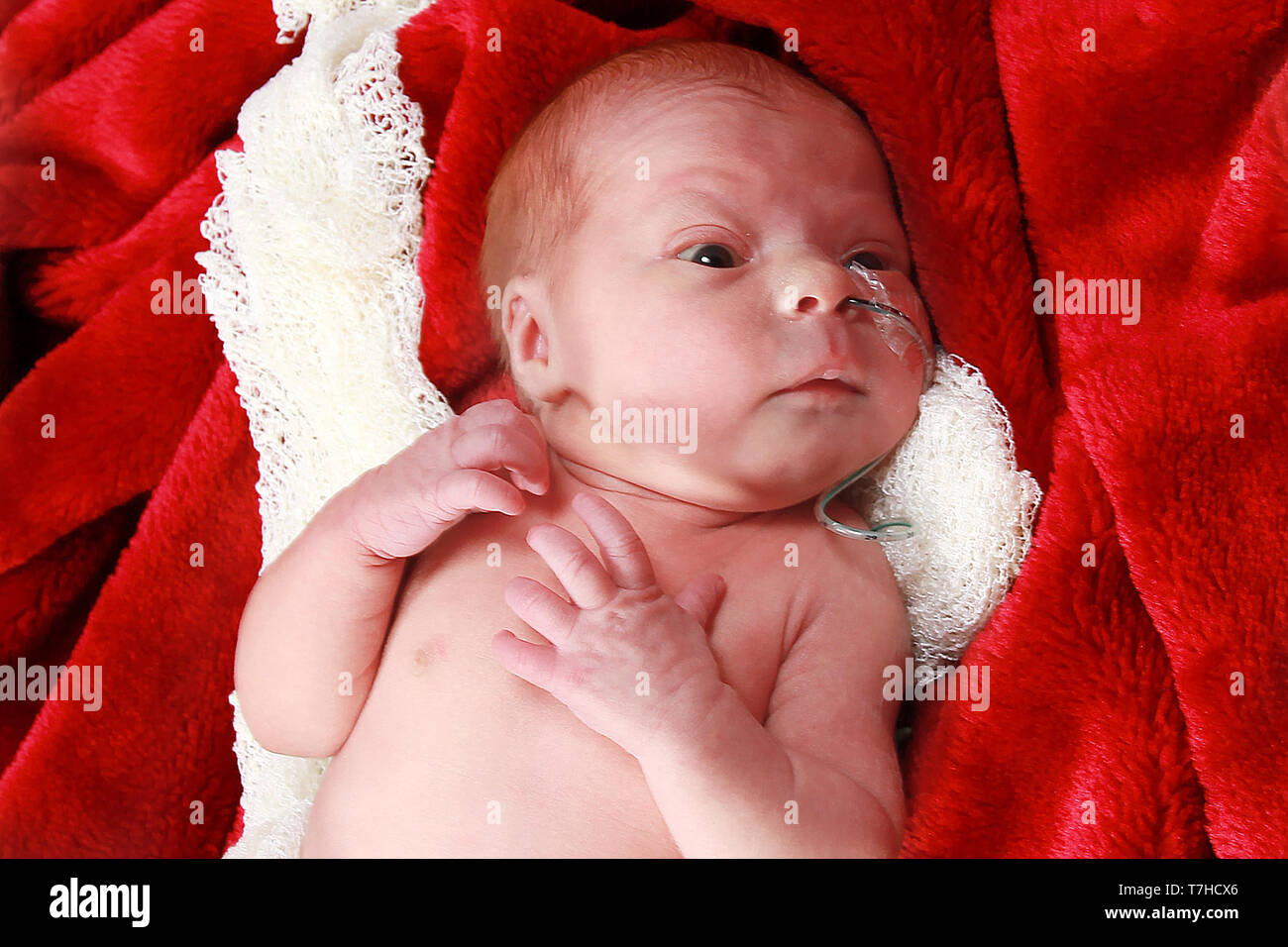 Bébé prématuré fille avec tube de gavage, tube NG Banque D'Images