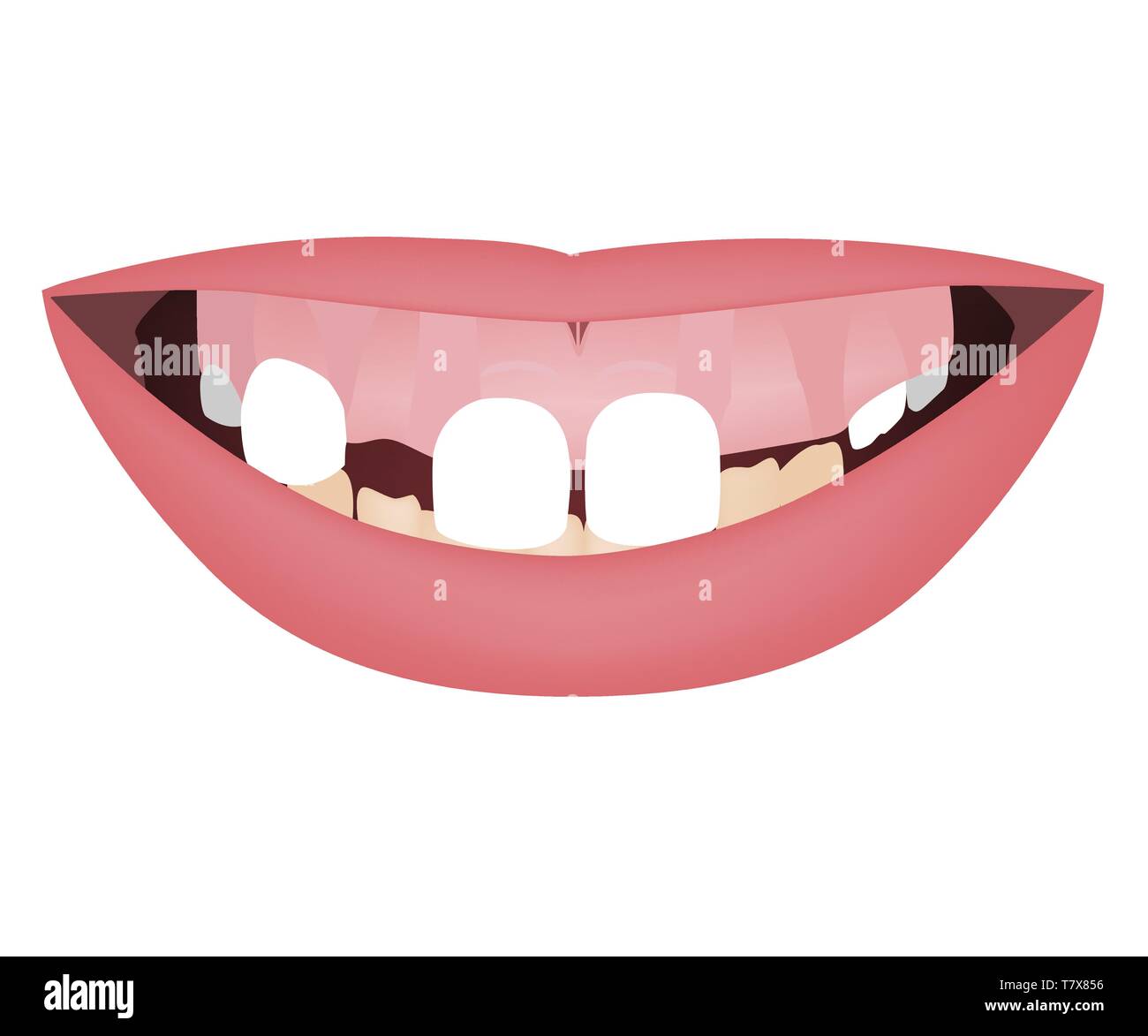 Kids jaws avec gummy smile, Crooked dents inférieures et distale bouchée avant de l'orthotropics orthotropics ou traitement. Vector illustration Illustration de Vecteur