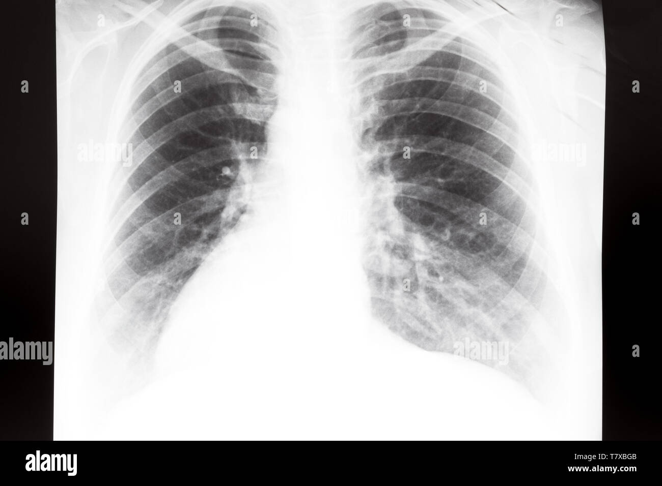 Vue avant du thorax humain avec poumons sur X-ray image Banque D'Images