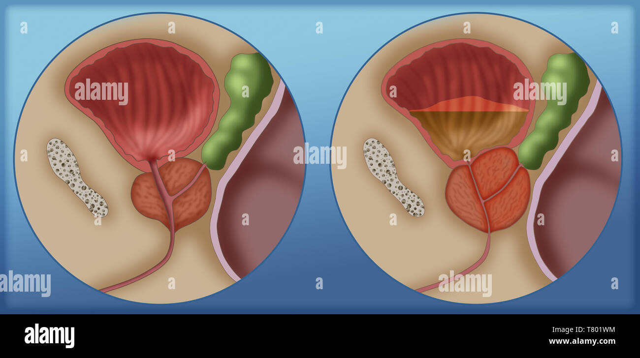 Comparaison de la prostate normale et l'élargissement de la prostate, illustration Banque D'Images