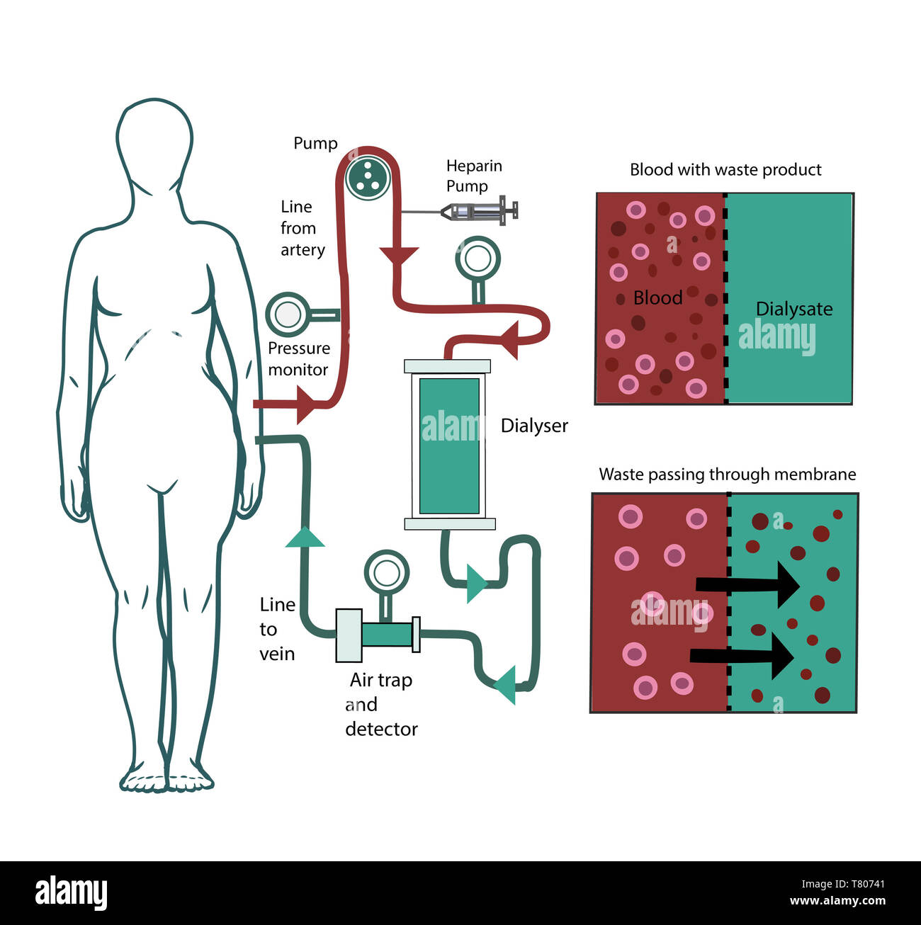 La dialyse, illustration Banque D'Images