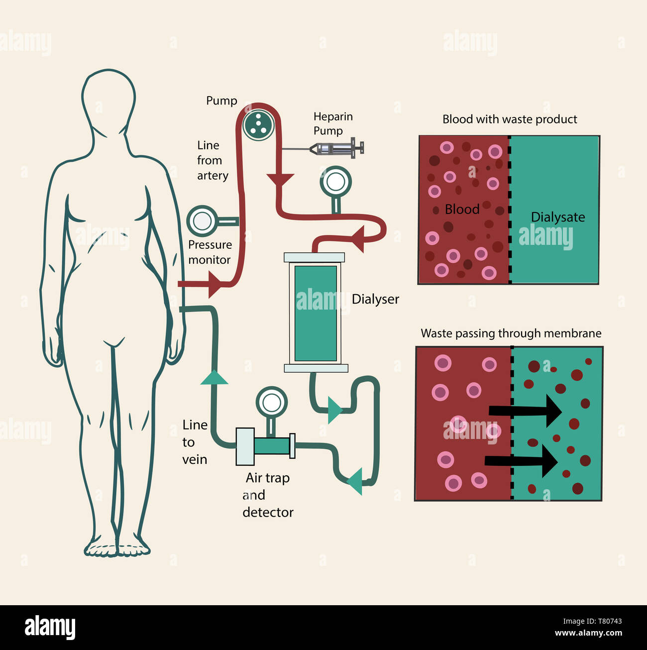 La dialyse, illustration Banque D'Images