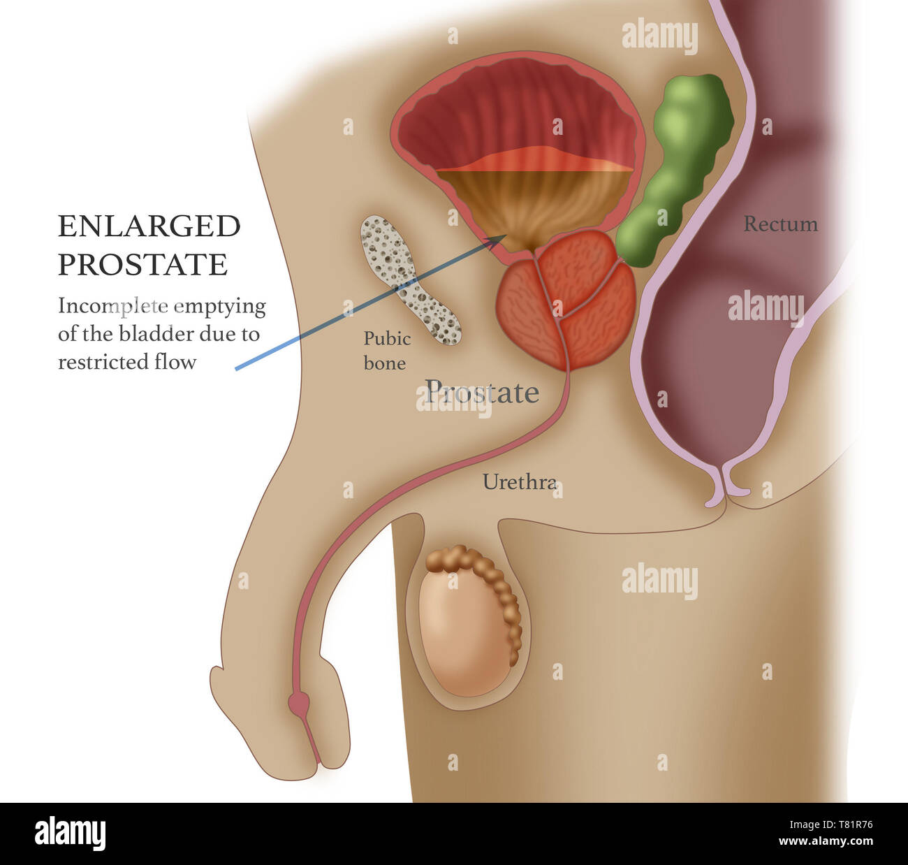 Élargissement de la prostate, illustration Banque D'Images
