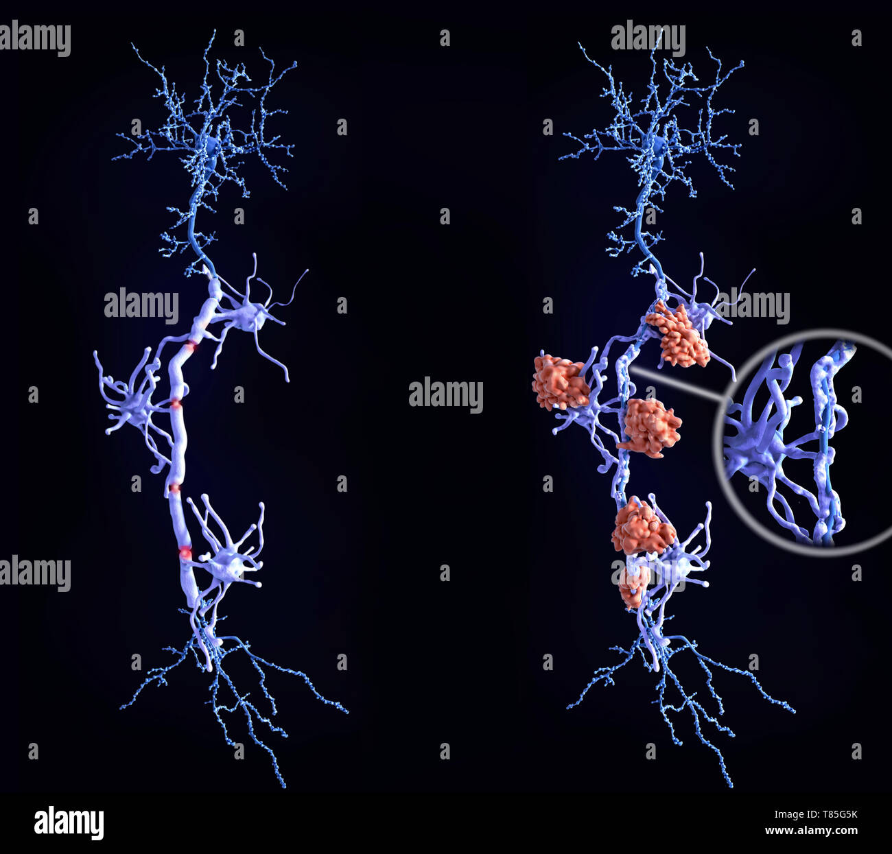 Les neurones sains et des lésions nerveuses dans la sclérose en plaques Banque D'Images