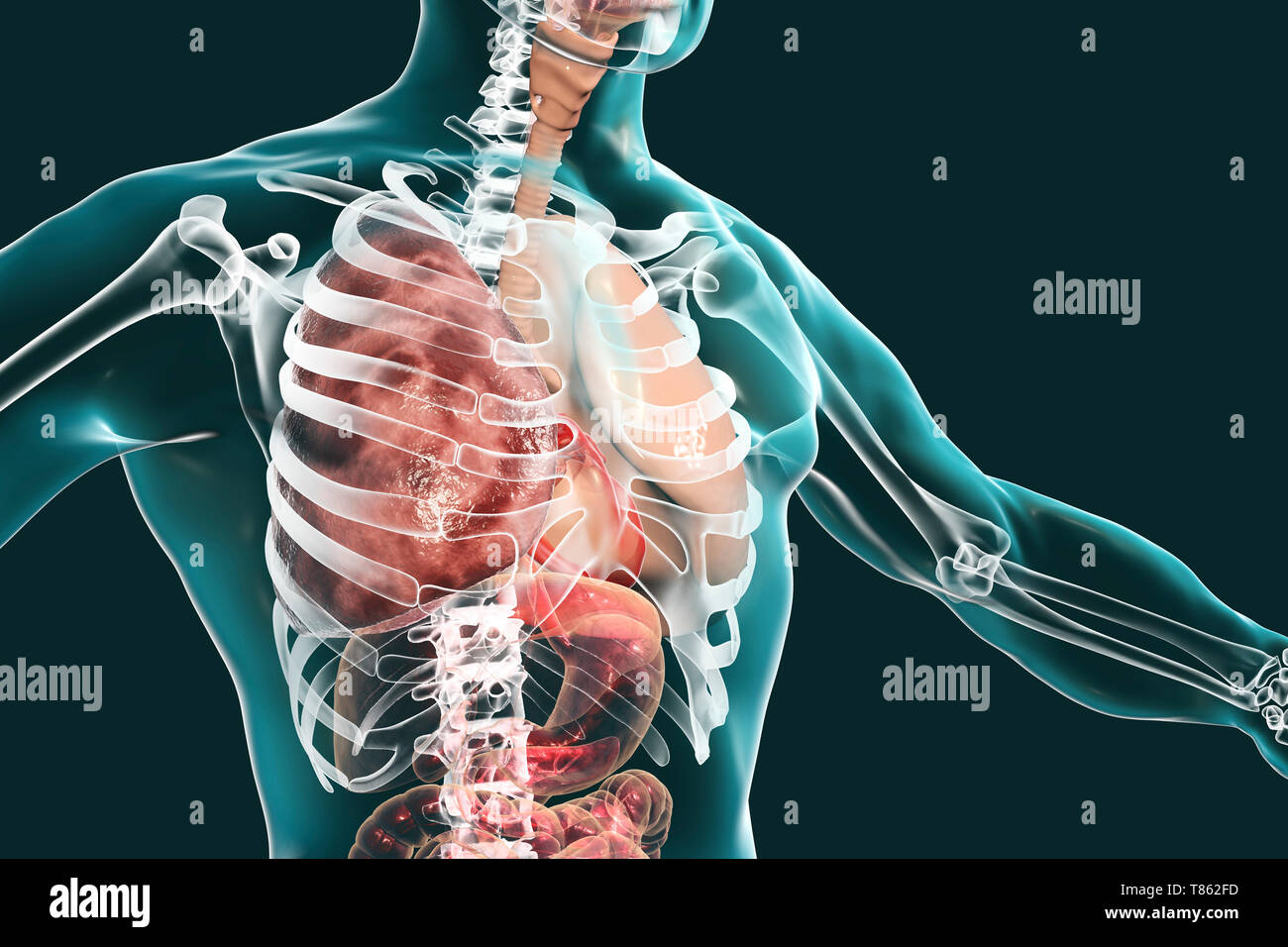 Hepatisation gris de pneumonie lobaire, illustration Banque D'Images