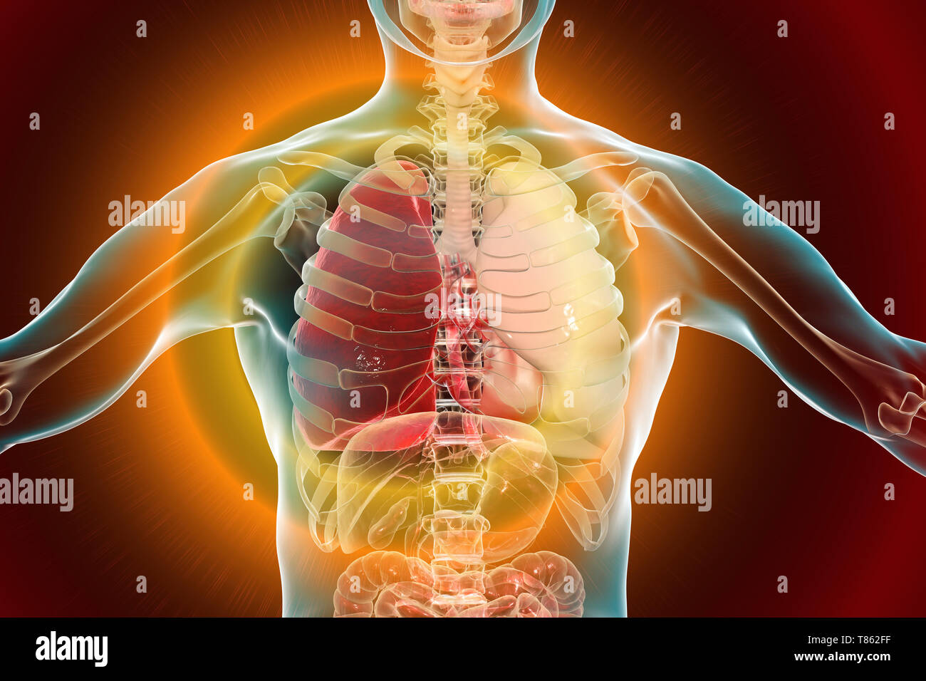 Hepatisation rouge de pneumonie lobaire, illustration conceptuelle Banque D'Images