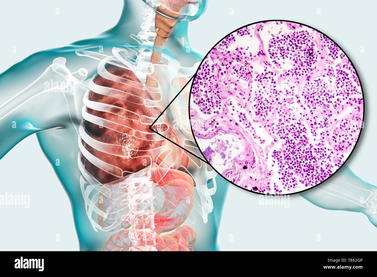 La pneumonie lobaire, illustration et lumière microphotographie Banque D'Images