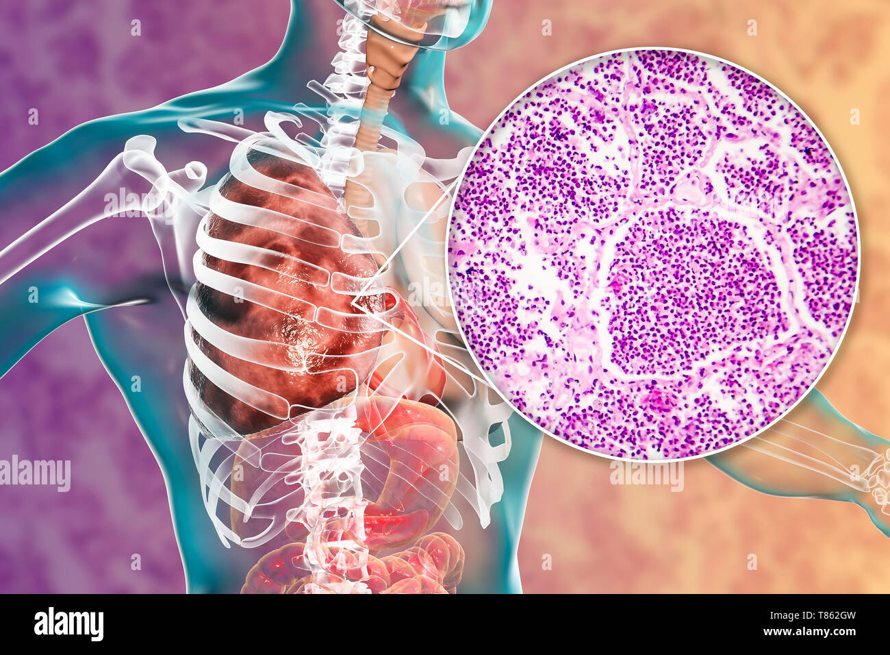 La pneumonie lobaire, illustration et lumière microphotographie Banque D'Images