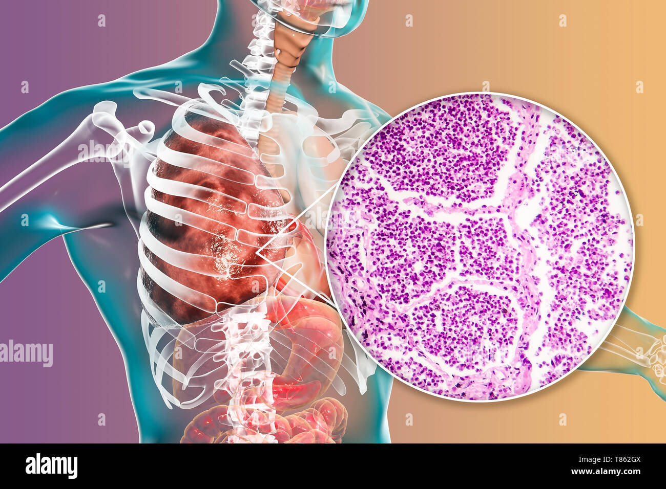 La pneumonie lobaire, illustration et lumière microphotographie Banque D'Images