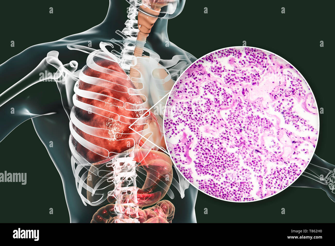 La pneumonie lobaire, illustration et lumière microphotographie Banque D'Images