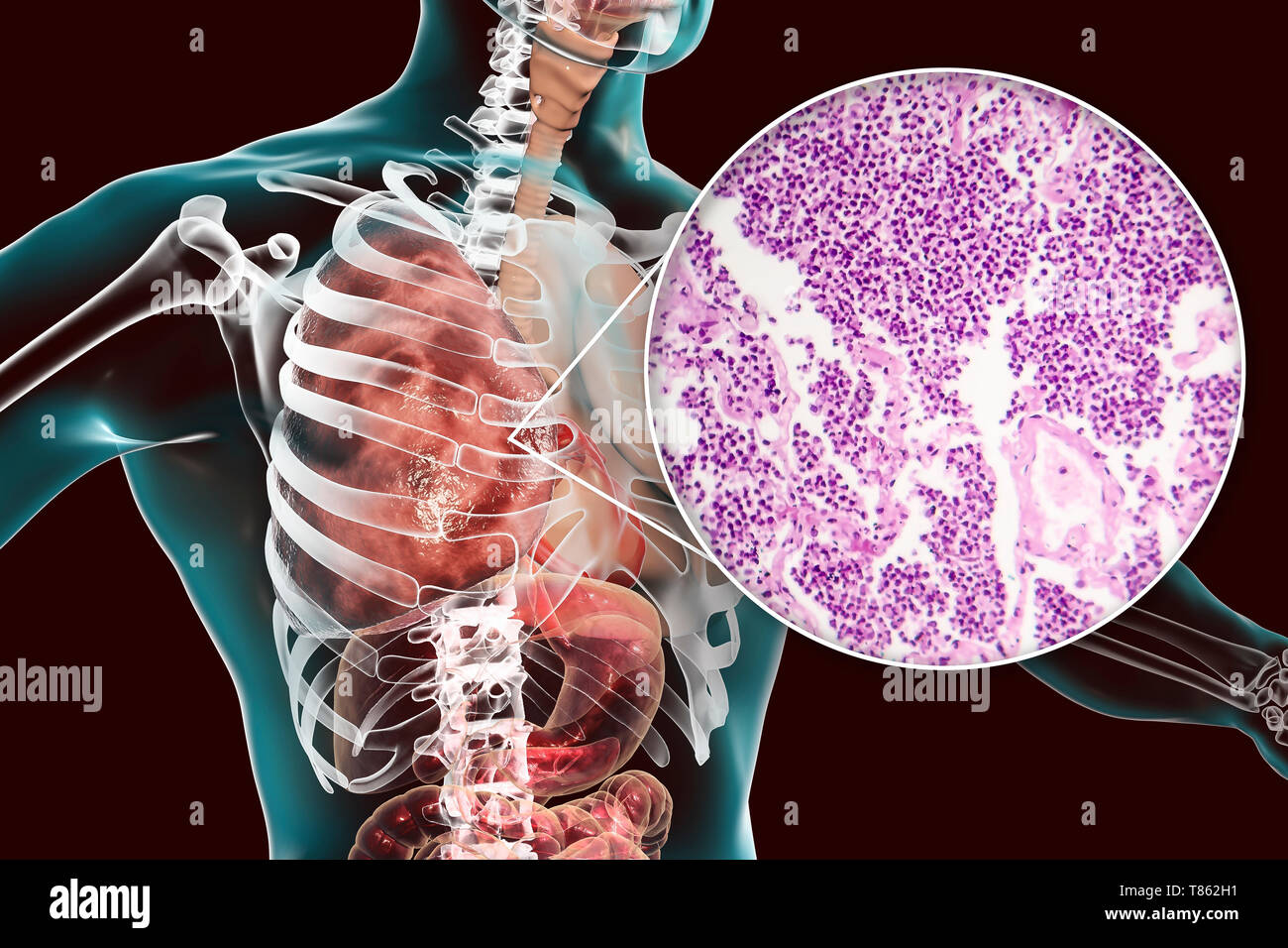 La pneumonie lobaire, illustration et lumière microphotographie Banque D'Images