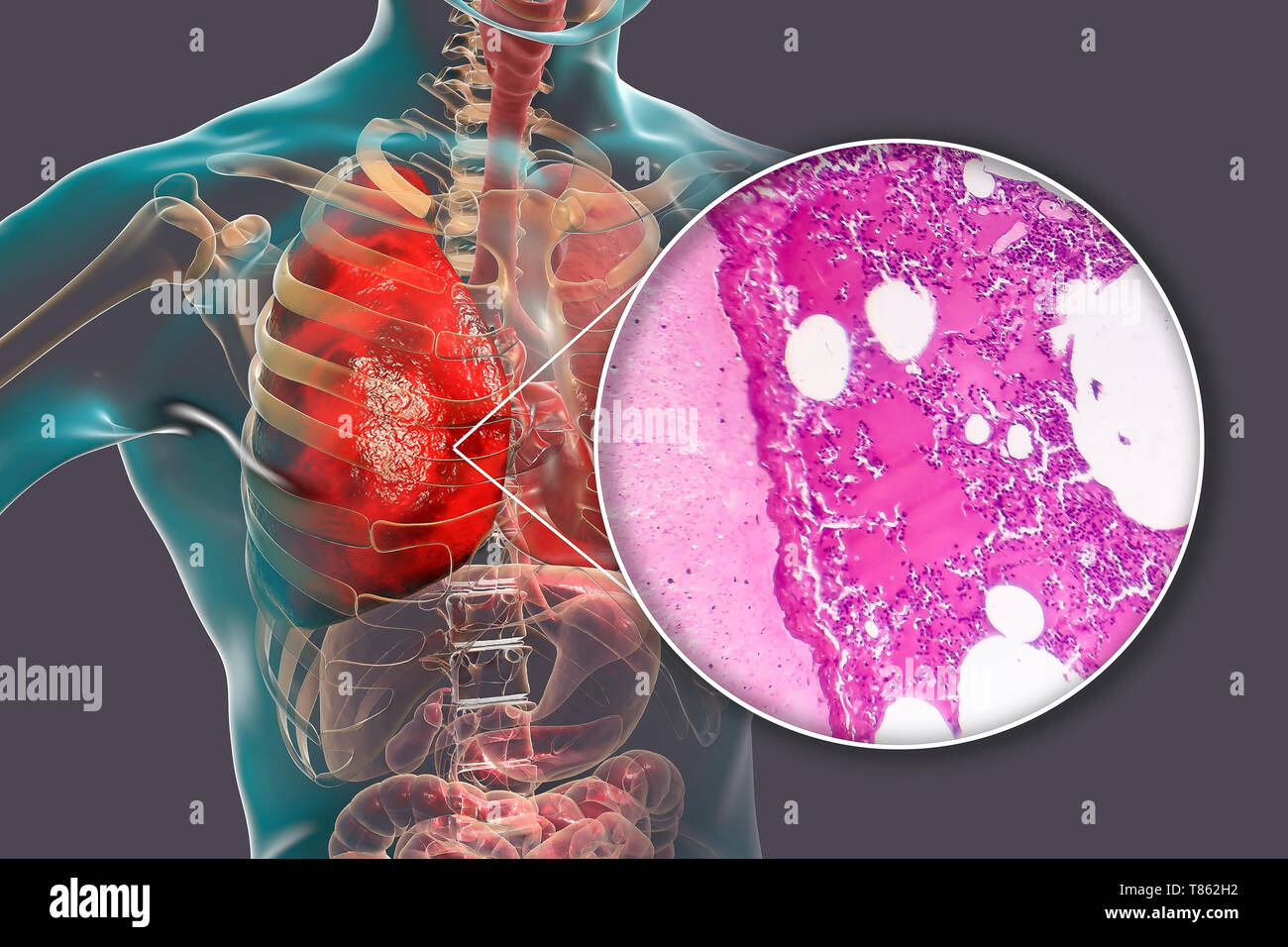 La pneumonie lobaire, illustration et lumière microphotographie Banque D'Images