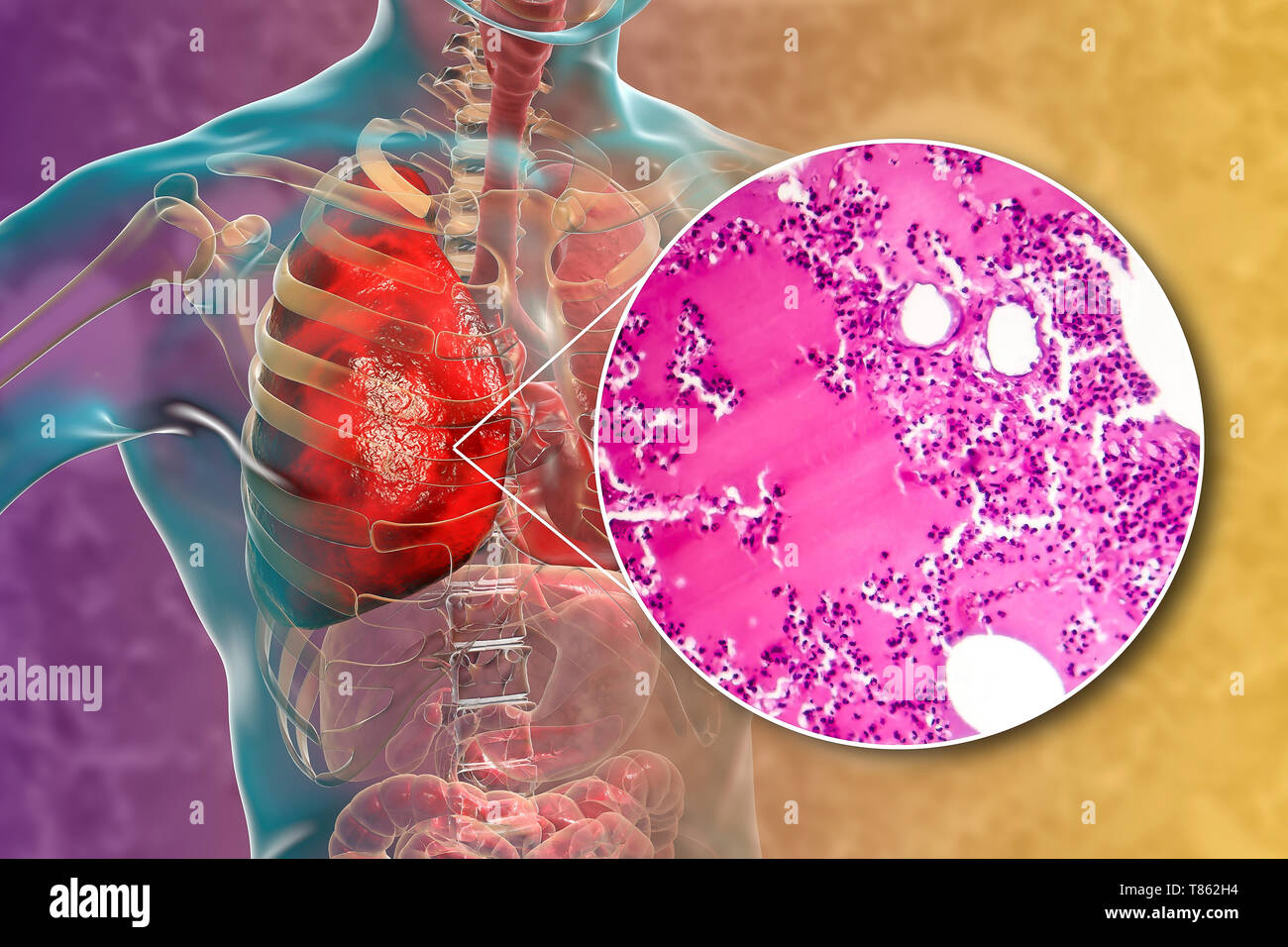 La pneumonie lobaire, illustration et lumière microphotographie Banque D'Images