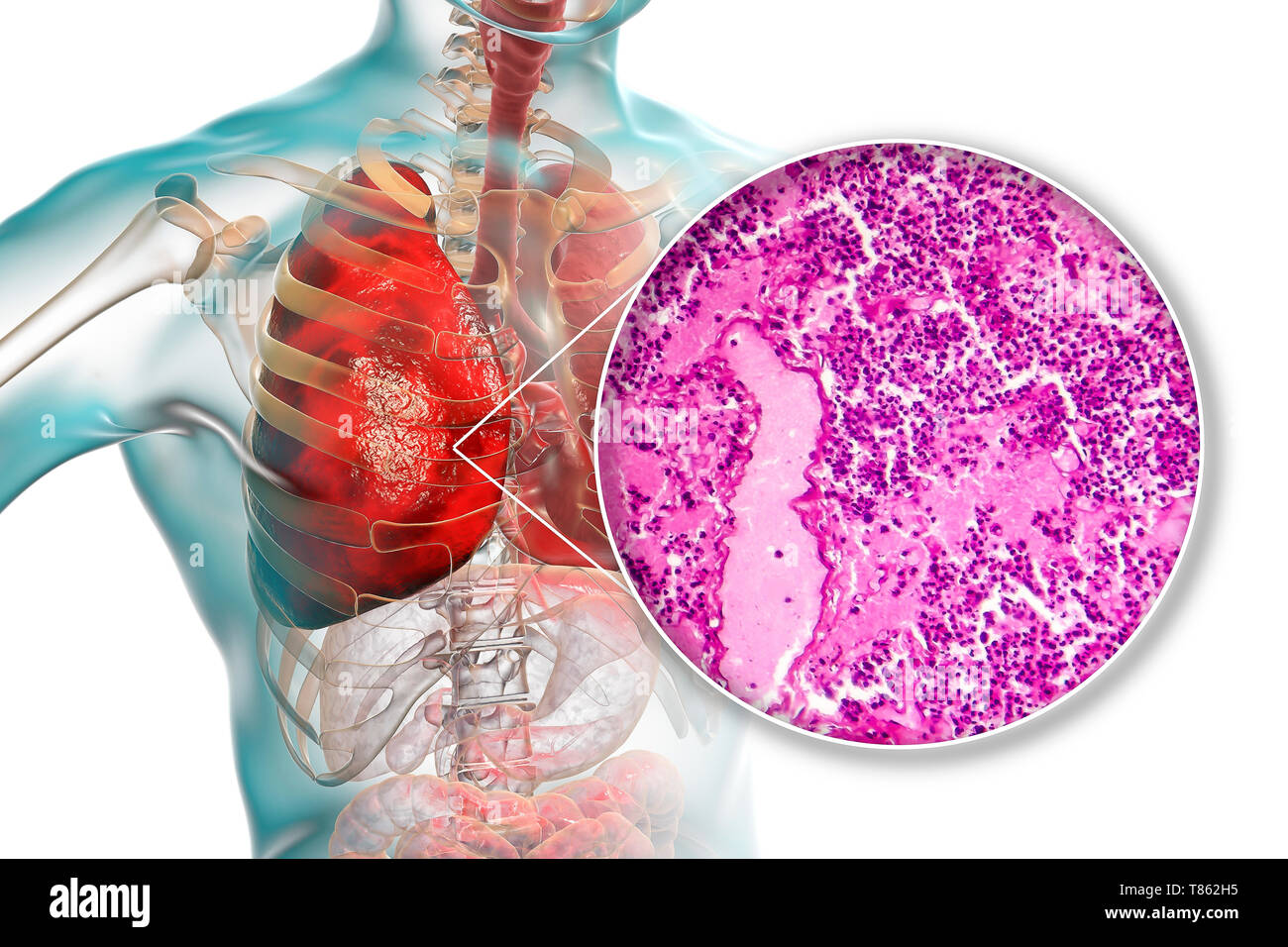 La pneumonie lobaire, illustration et lumière microphotographie Banque D'Images