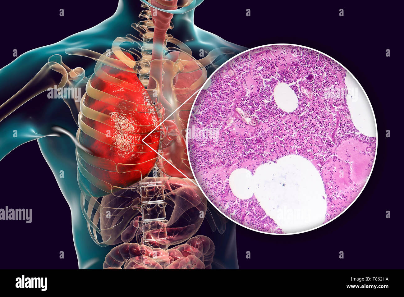 La pneumonie lobaire, illustration et lumière microphotographie Banque D'Images
