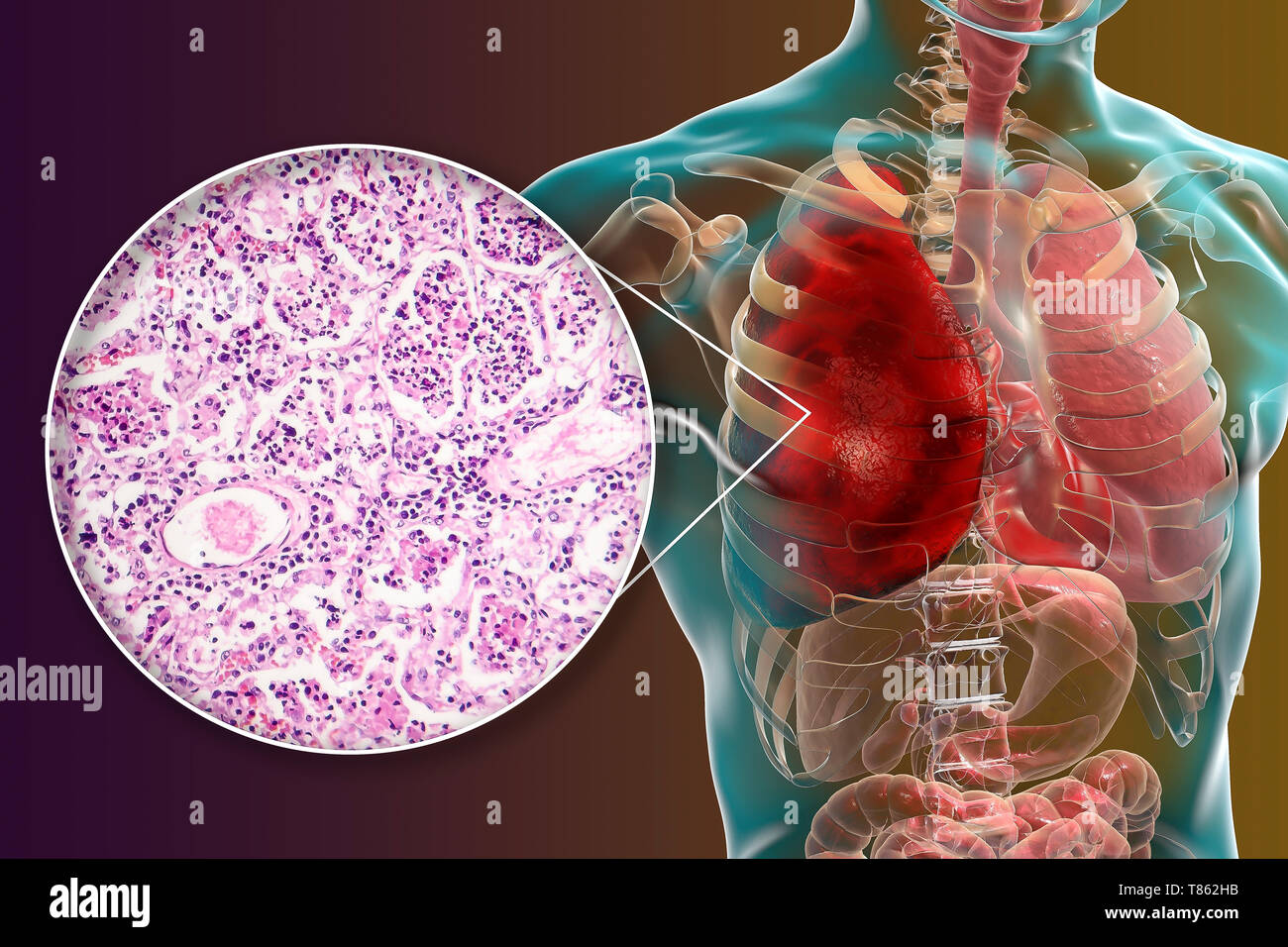La pneumonie lobaire, illustration et lumière microphotographie Banque D'Images