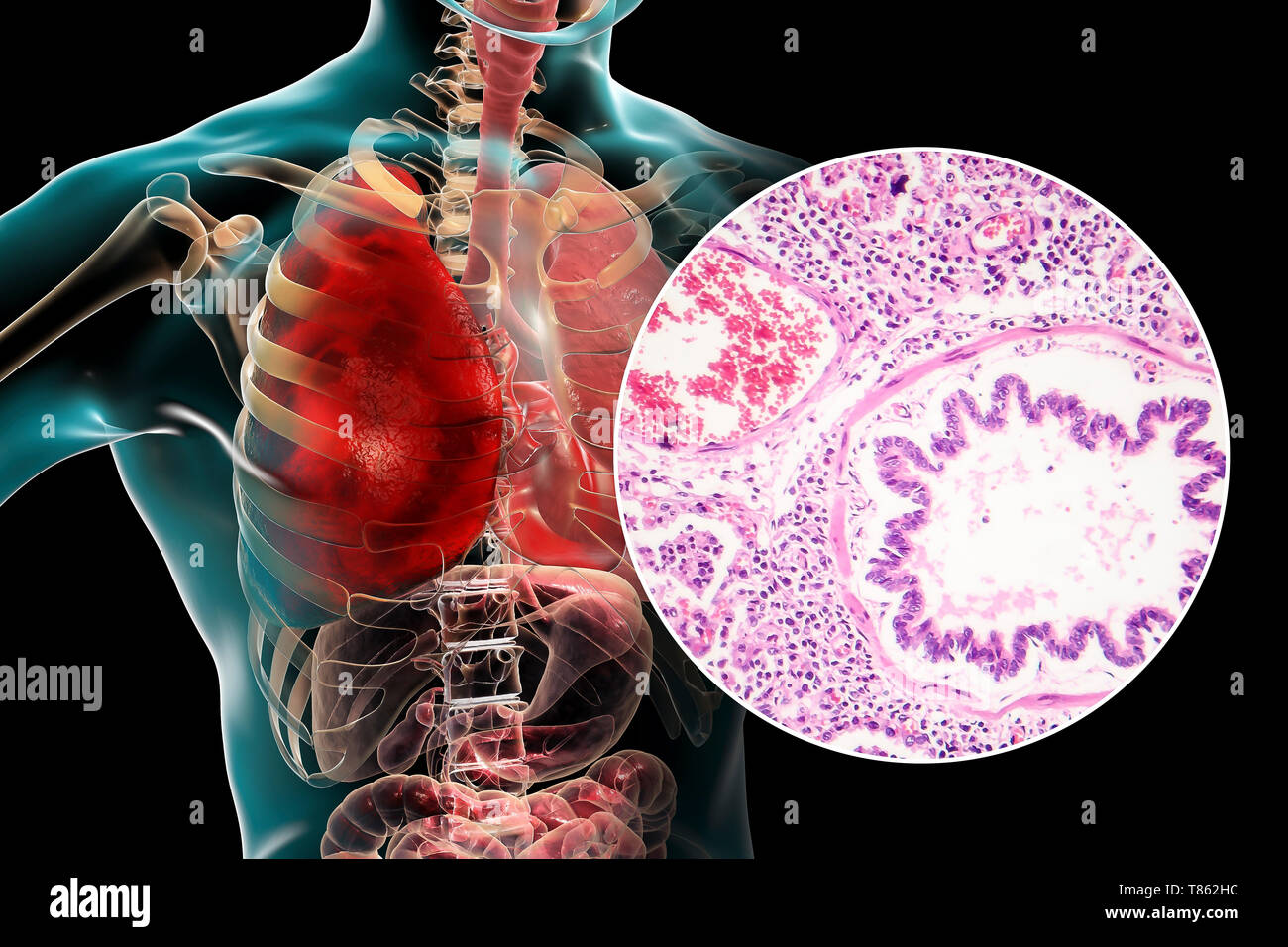 La pneumonie lobaire, illustration et lumière microphotographie Banque D'Images