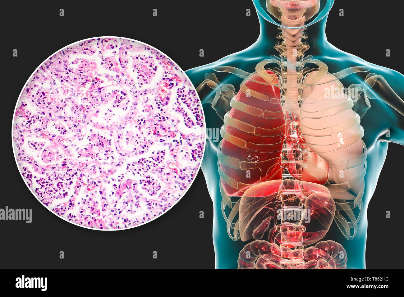 La pneumonie lobaire, illustration et lumière microphotographie Banque D'Images